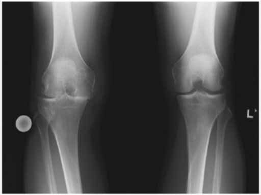 standard_Gonartrose_PMC3874223_10.1177_1941738113501460-fig1 terd artrozis